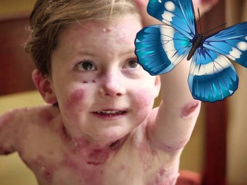 Kəpənək xəstəliyi ilə mübarizəyə&nbsp;1,3&nbsp;milyon&nbsp;vəsait ayrıldı