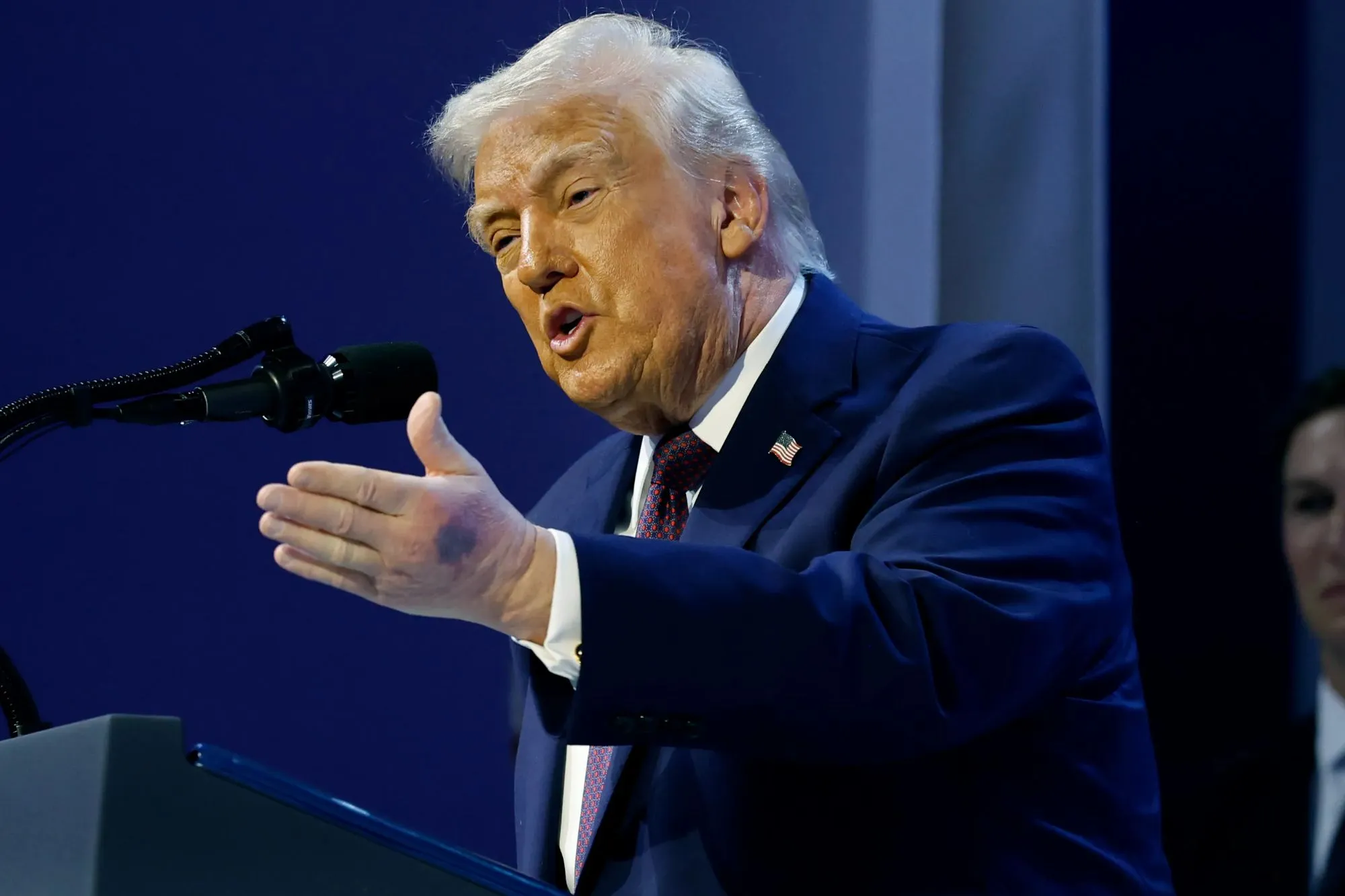 Trampın əllərinə nə olub?