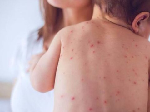 Azərbaycanda 10 nəfər qızılcaya&nbsp;yoluxub