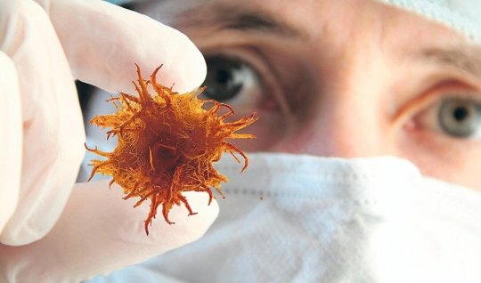 Azərbaycanda xərçəngin yayılan formaları - Qorxunc STATİSTİKA