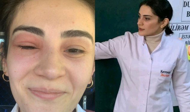 Gözünü arı sancan kimya müəllimi: “Tək gözlə 55 bal topladım”