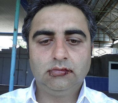Azərbaycanda sahibkar milyarderə etiraz əlaməti olaraq ağzını tikib