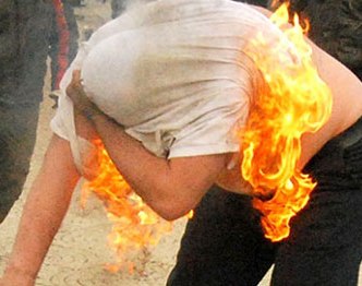 Bakıda borca görə özünü yandıran kişinin üzünə dəri köçürüləcək