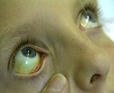 Hepatitlərə yoluxmağından şübhələnənlər üçün pulsuz MÜAYINƏ