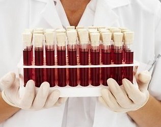 Azərbaycanda ən çox bu iki qrupdan olan qana ehtiyac var