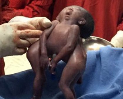 Siam əkizləri öldü