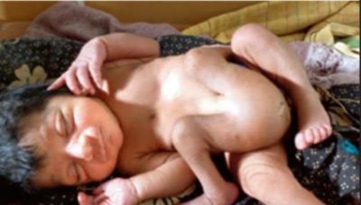 Dörd ayaqlı uşaq doğulub - FOTO