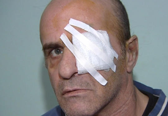 Ruhi əsəb dispanserində dava:  xəstənin gözün çıxarıblar
