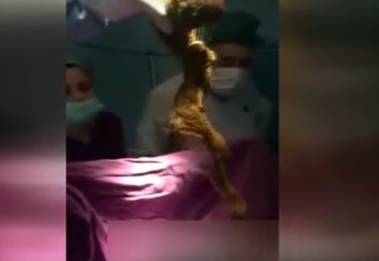 Bakıda 22 yaşlı qızın mədəsindən 4 kq t&uuml;k &ccedil;ıxıb - VİDEO 