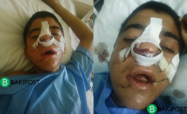 Azərbaycanda müəllim şagirdini ölümcül hala salıb - FOTO   