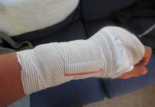 Ağsuda sağlam uşağın qoluna gips qoyublar - VİDEO
