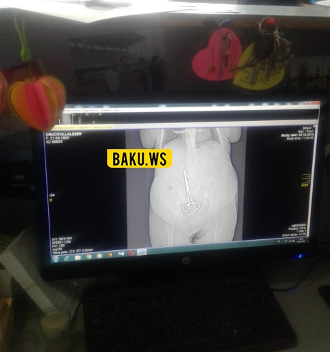 Azərbaycanda həkimlər qadının bədənində qayçı saxladılar - FOTOLAR