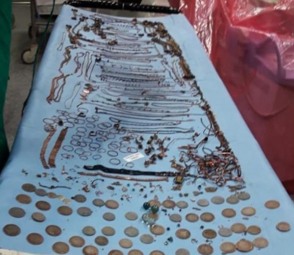 Hindistanda gənc qadının mədəsindən 2 kilo qızıl sikkə çıxarıldı