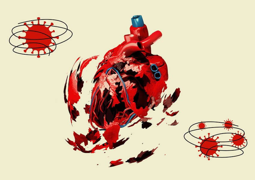 COVID-19 keçirmiş insanların ürəyində koronavirus izi aşkarlandı