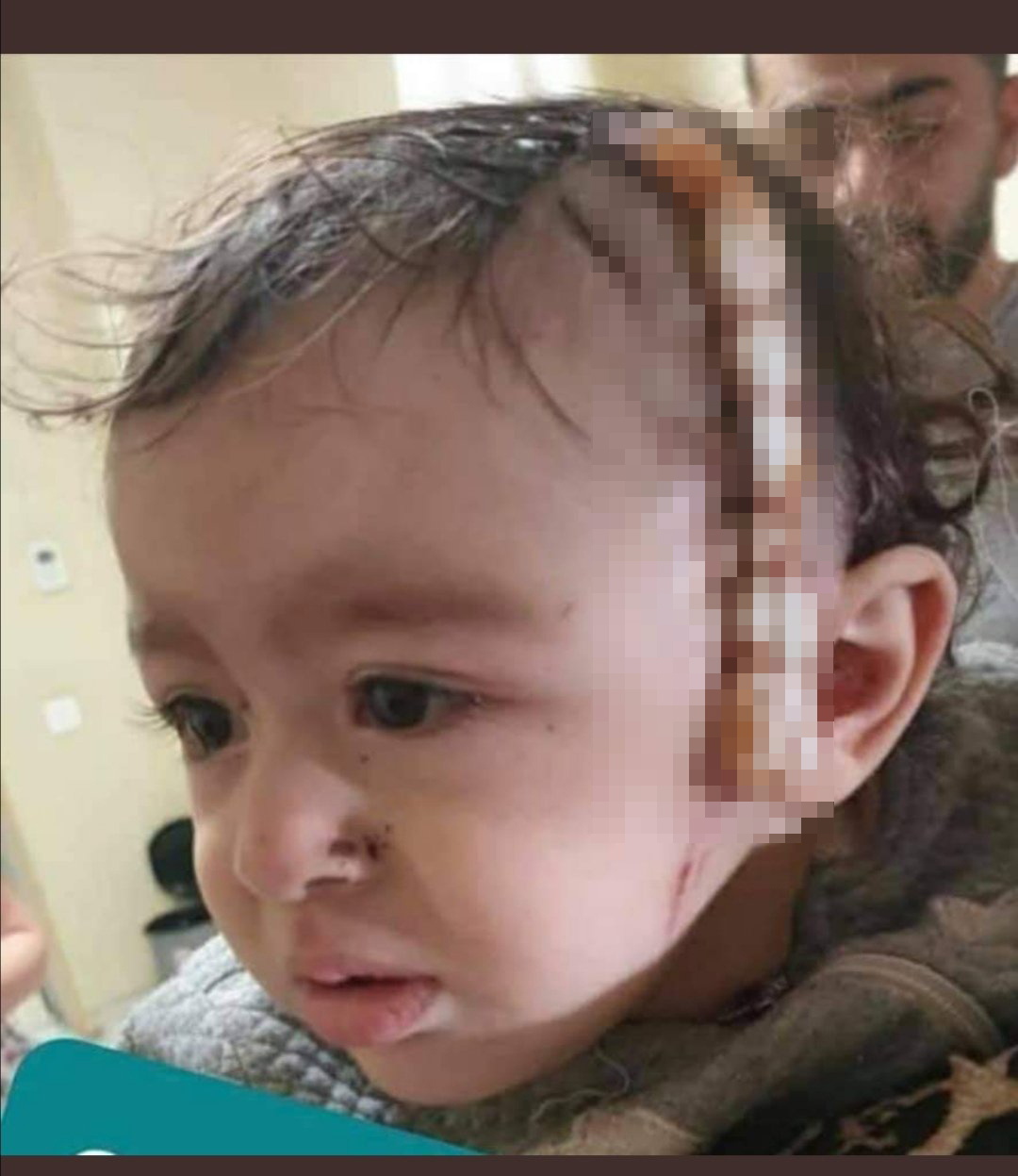 Prezidentin köməkçisi Gəncədə yaralanan 10 aylıq Zəhranın fotosunu paylaşdı