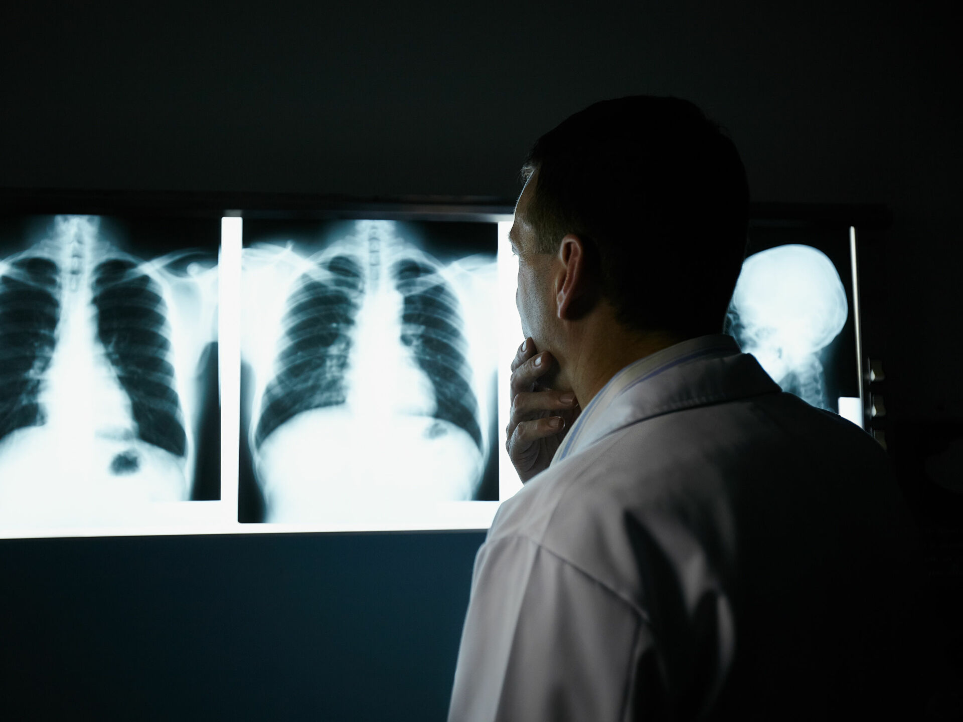 Hər gün 4500 insan vərəmdan ölür