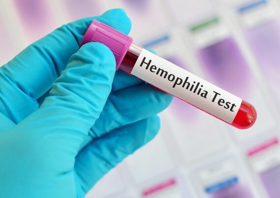 Hemofiliyalı xəstələrin sayı AÇIQLANIB