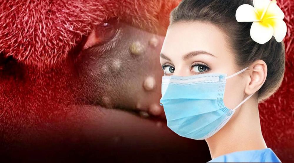 Türkiyədə meymunçiçəyinə yoluxma sayı artıb