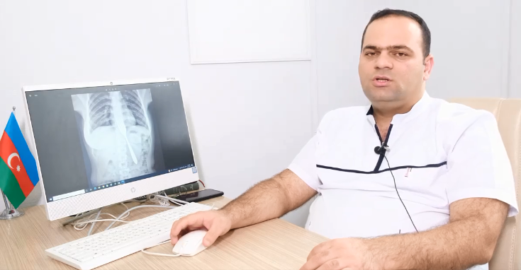 21 yaşlı qızın bədənindən çəngəl çıxarıldı - VİDEO