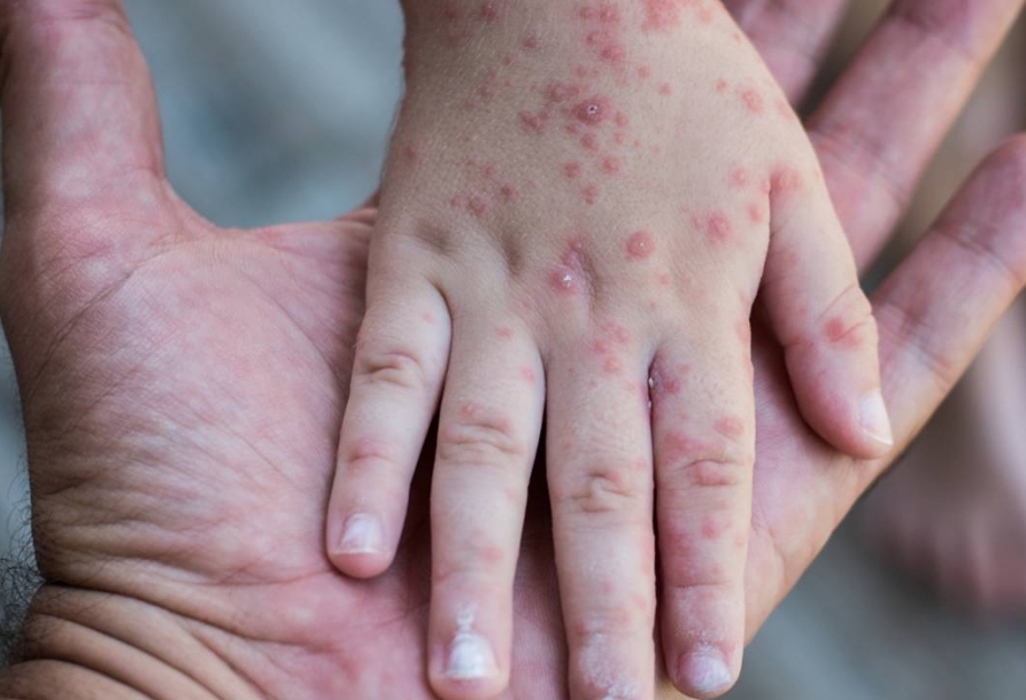 Dağıstanda qızılcaya kütləvi YOLUXMA