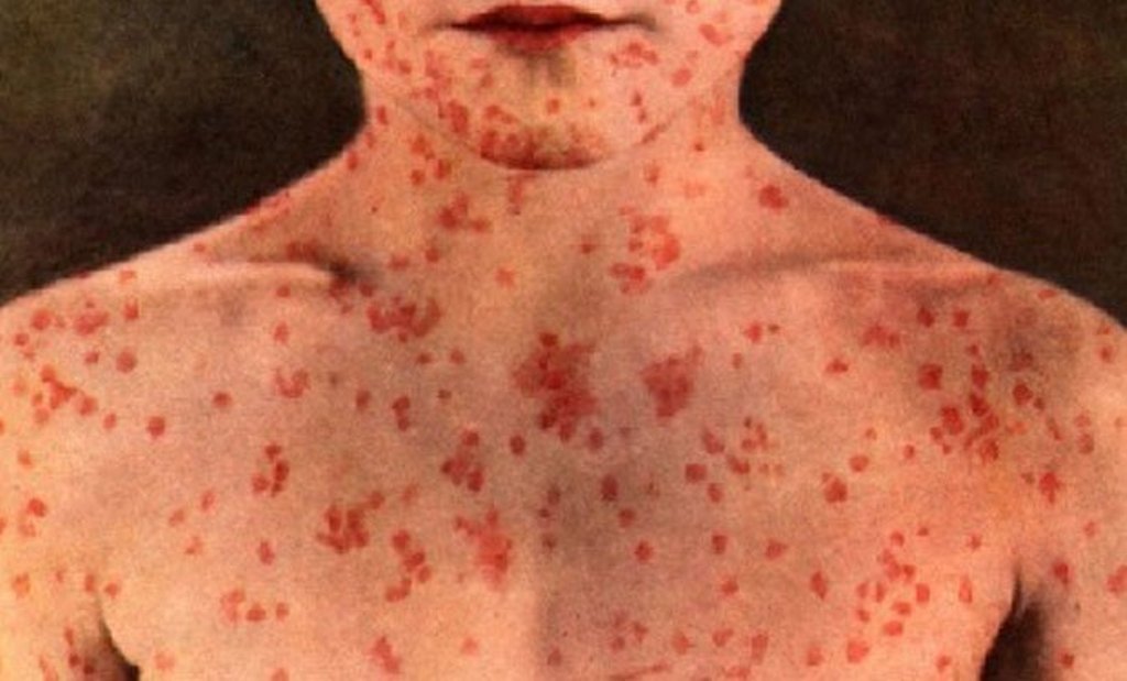 Qızılcaya yoluxma artır - ÜST-dən həyacan təbili