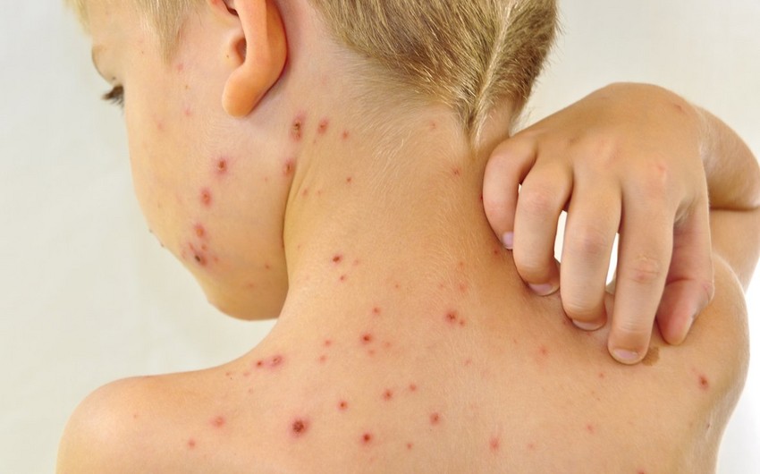 Azərbaycanda qızılca ilə bağlı narahatlıq yoxdur - ÜST