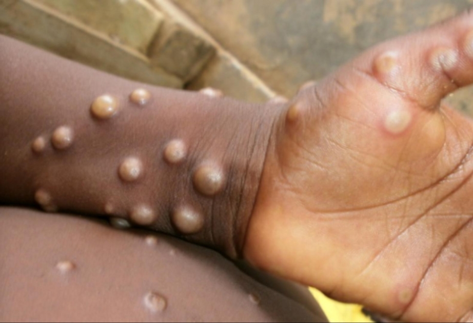 ÜST-dən meymunçiçəyi ilə bağlı QƏRAR 