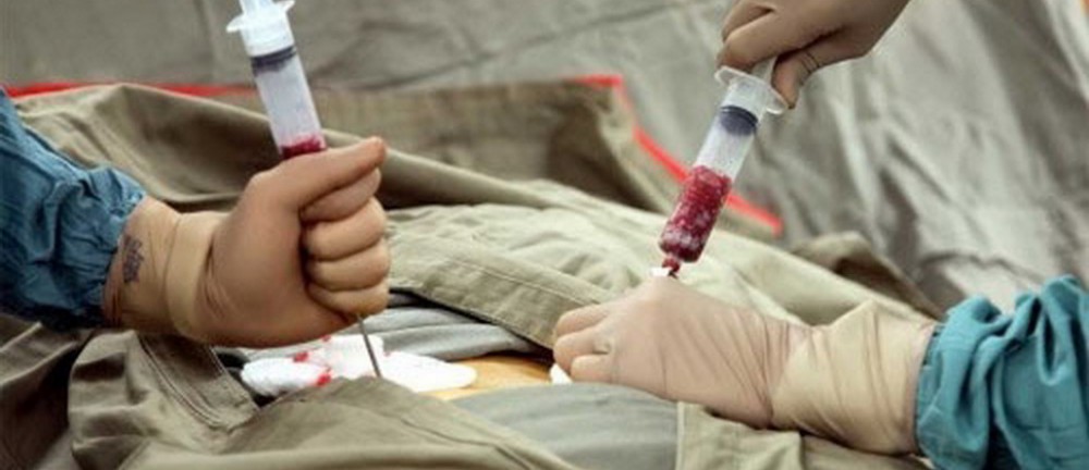 Sümük iliyi transplantasiyası cərrahi müdaxilə olmadan həyata keçiriləcək