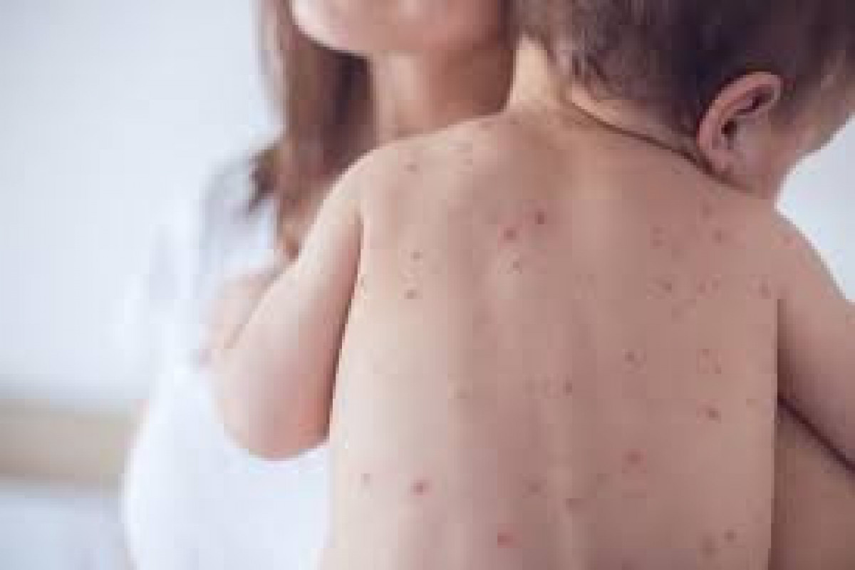 Qızılca zamanı hər an ağırlaşmalar baş verə bilər - Epidemioloq
