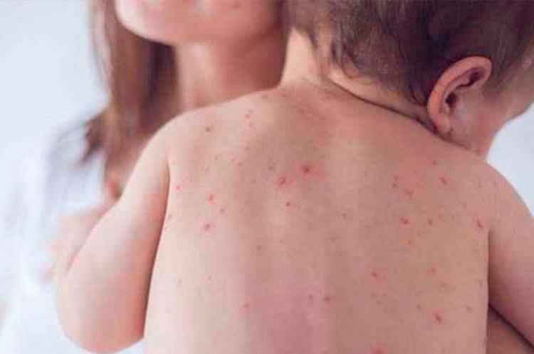 Ermənistanda qızılca tüğyan edir - Yoluxma ARTDI