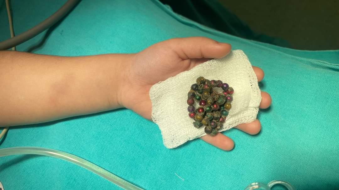 Azərbaycanda dəhşət: 4 yaşlı uşaq 53 ədəd maqnit uddu - FOTO