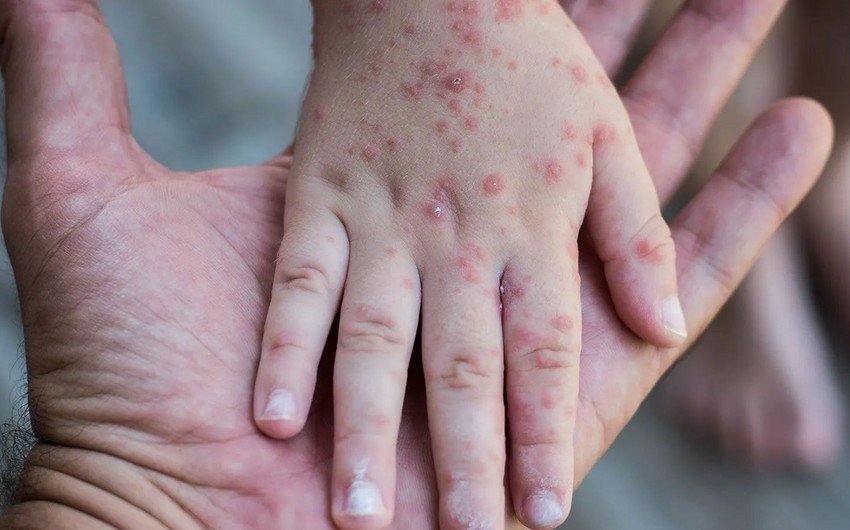 Karantin dövrü bitmədən uşaqları məktəbə göndərmək olmaz - Pediatr