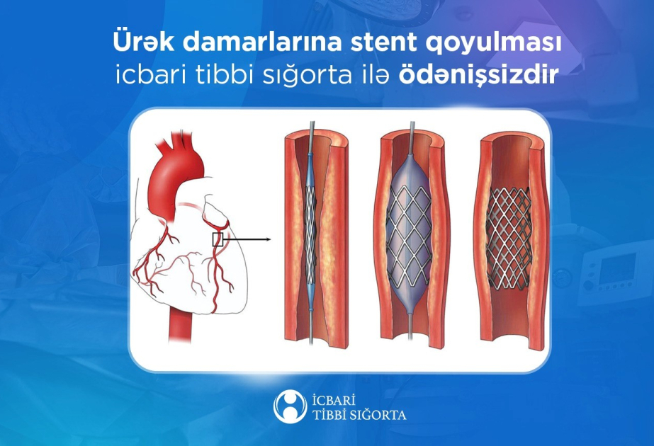 Ürək damarlarına stentin qoyulması pulsuzdur - İcbari tibbi sığorta