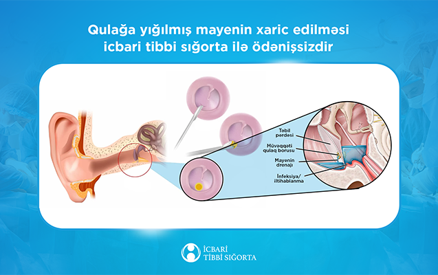 İcbari tibbi sığorta bu əməliyyatı da qarşılayır
