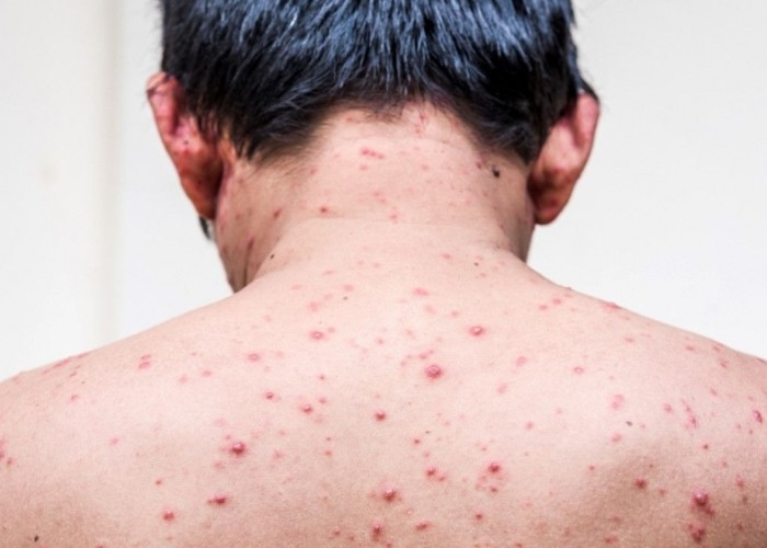 Meymunçiçəyi qorxulu epidemiya deyil - Azərbaycanlı infeksonist