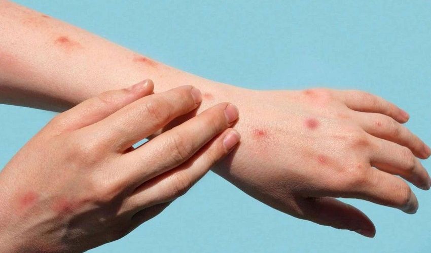 Meymunçiçəyinə yoluxan şəxs evə buraxıldı