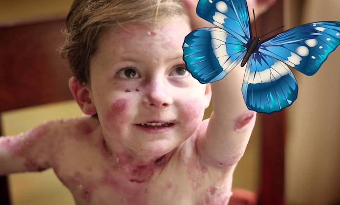 Kəpənək xəstəliyi ilə mübarizəyə&nbsp;1,3&nbsp;milyon&nbsp;vəsait ayrıldı