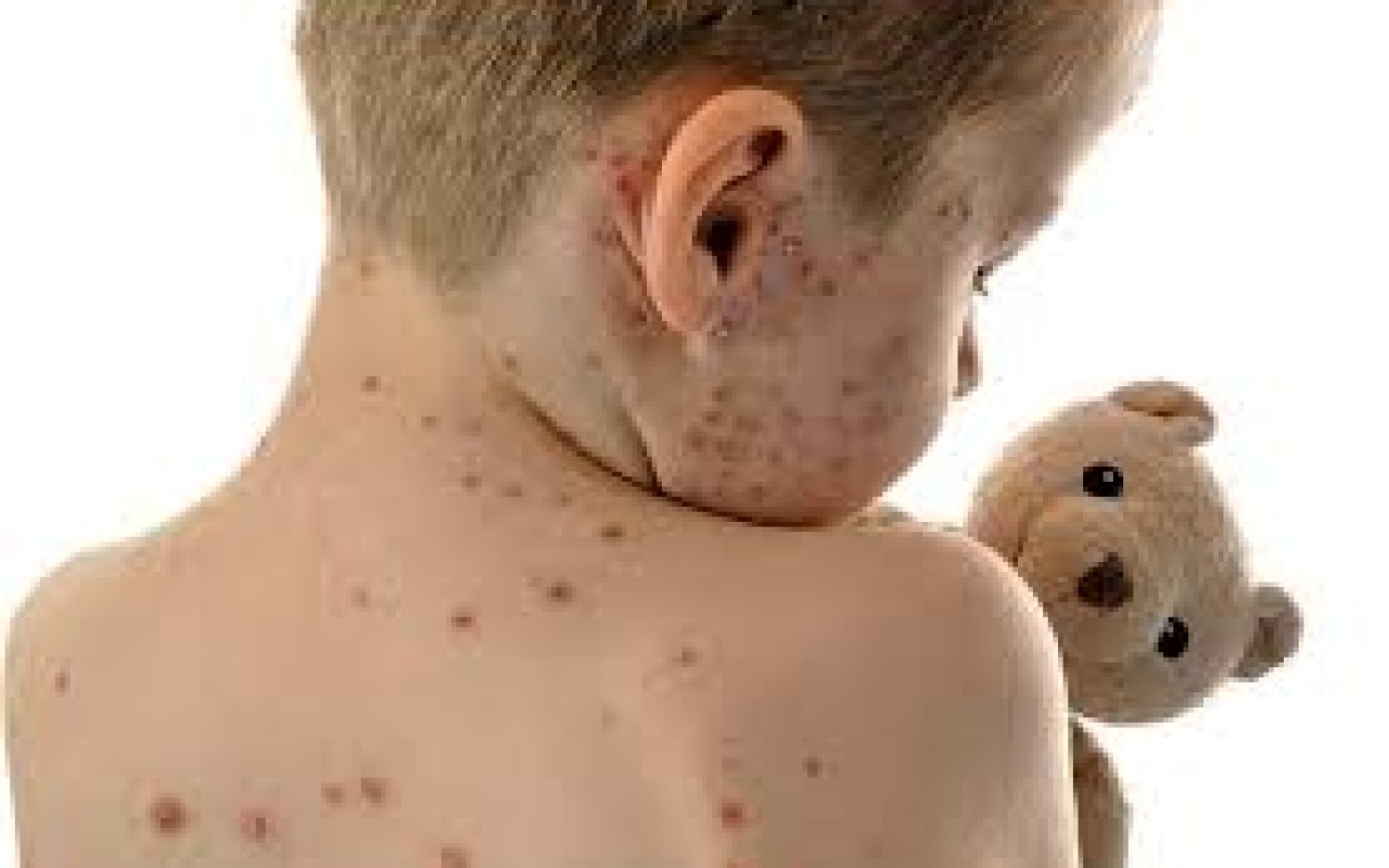 Uşaqlar arasında suçiçəyi xəstəliyi yayılıb -&nbsp;VİDEO