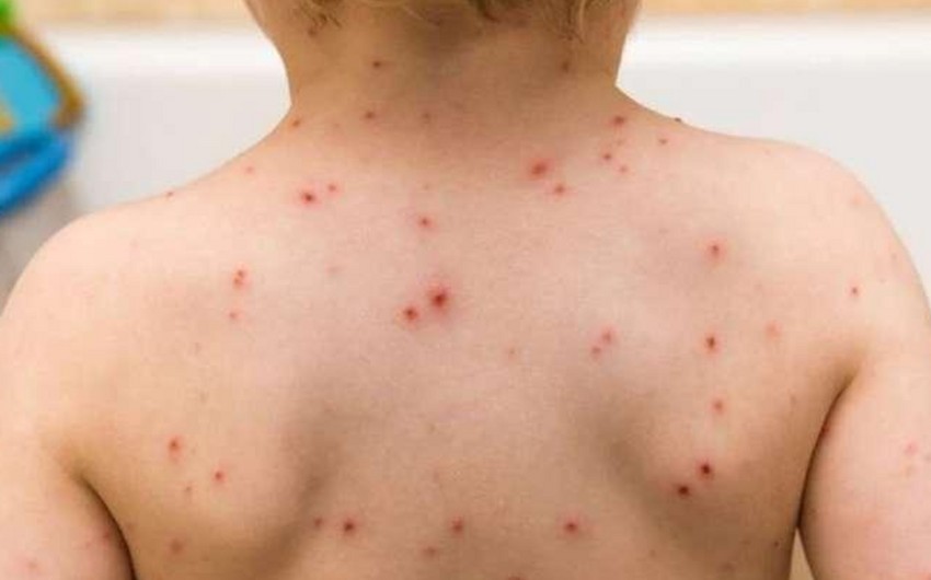 Azərbaycanda 1 yaşlı uşaq qızılcadan öldü