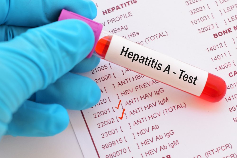 Azərbaycanda hepatitə yoluxma 30 dəfədən çox azalıb