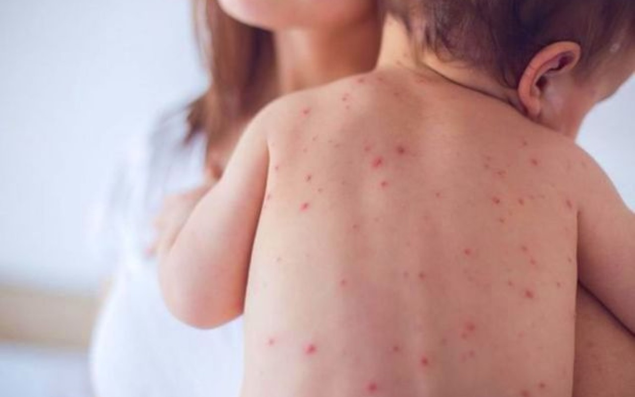 Azərbaycanda 10 nəfər qızılcaya&nbsp;yoluxub